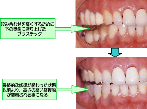 顎関節症の始まりとその果てに待っているもの